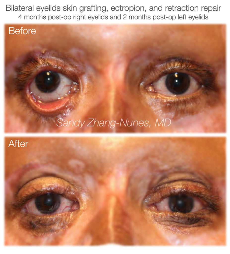 The Ability to Blink How Oculoplastics Saved a Burn Victim’s Eyelids