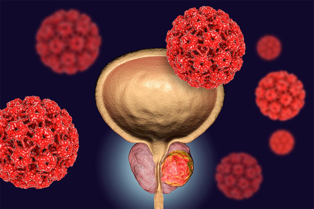 A graphic drawing of a prostate with a tumor.