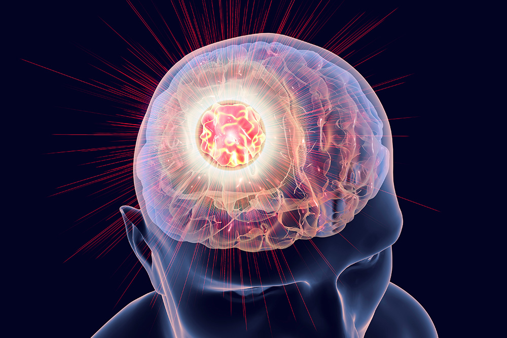 Rendering of a brain with a brain tumor.