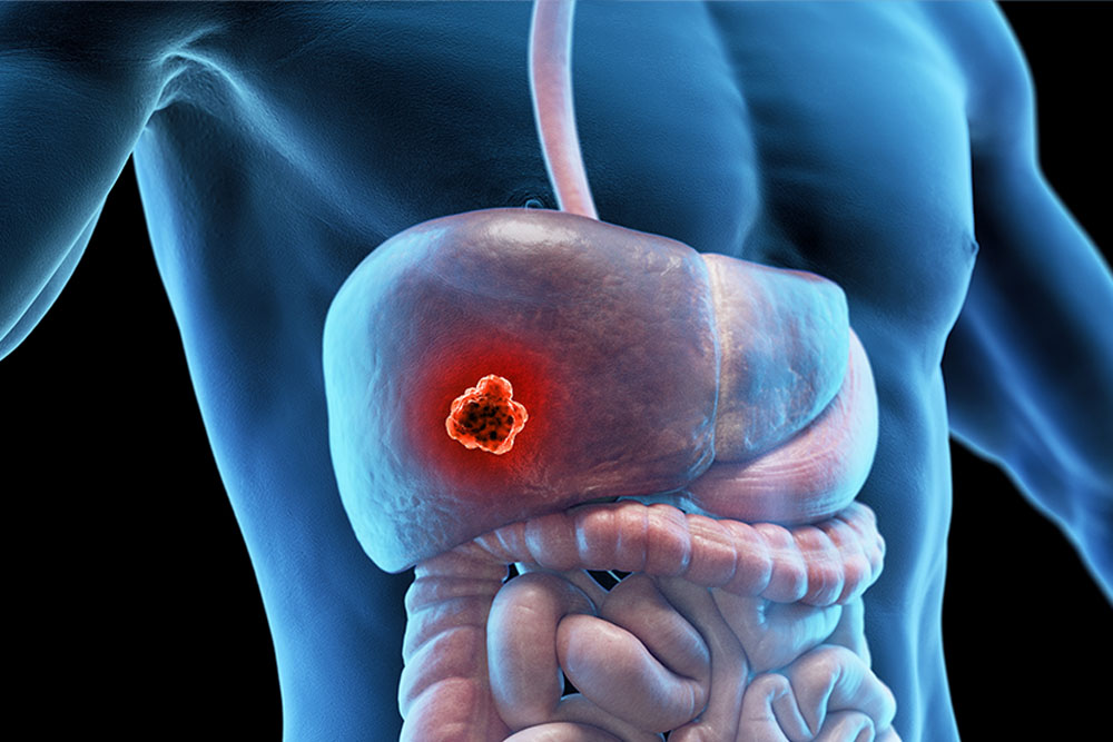 Robotic Surgery for Complex Hepatobiliary Cases: Expanding the Frontier